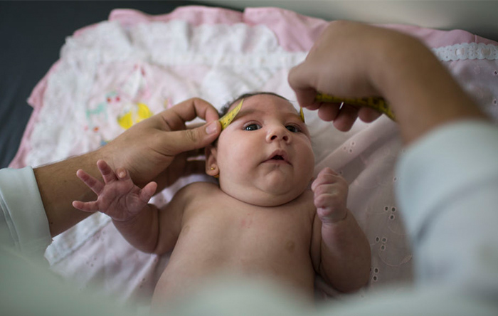 ویروس زیکا منجر به تولد نوزادانی مبتلا به میکروسفالی یا سر کوچک می‌شود.