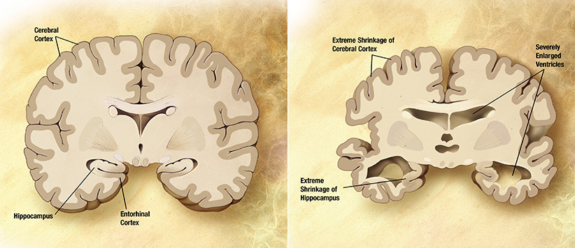 مقایسه‌ی مغز سالم با مغز مبتلا به آلزایمر