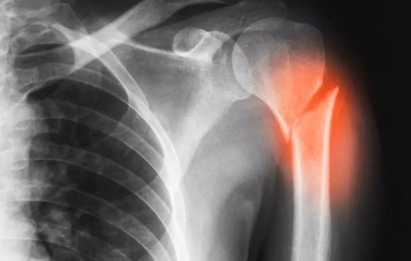 پیوند استخوان