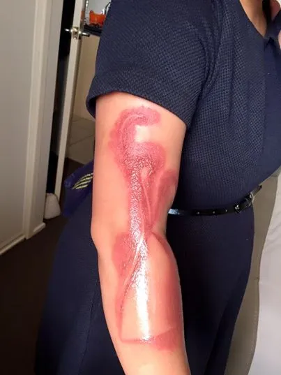 melanie-tan-pelaez-suffers-a-second-degree-burn-on-her-right-arm-after-falling-asleep-on-her-iphone-7