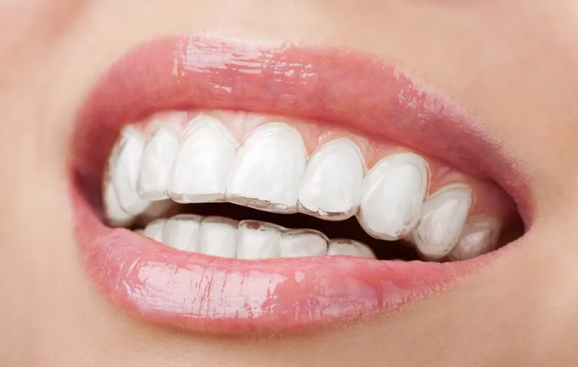 بلیچینگ دندان