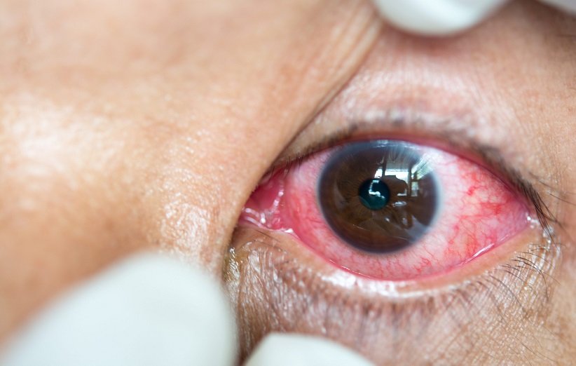 عوارض لنز چشم