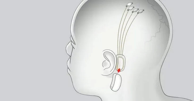 ایمپلنت مغزی