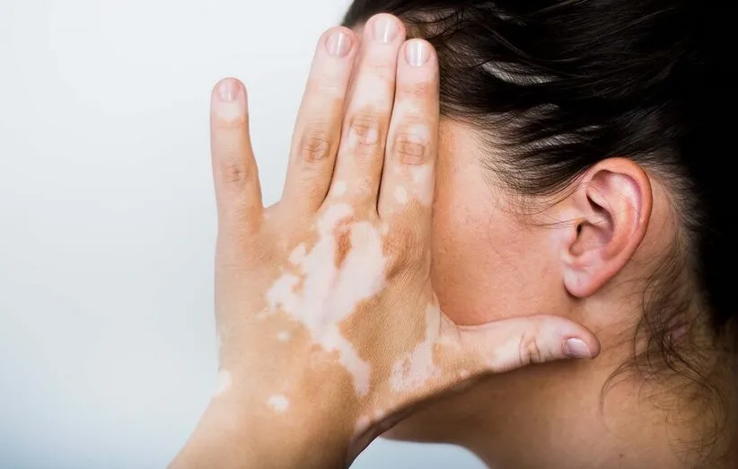 علادم برص یا پیسی