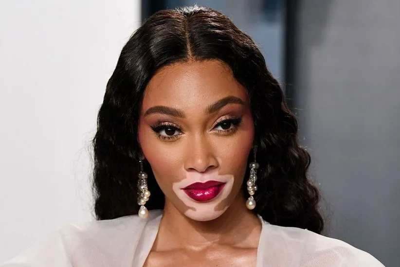 انواع بیماری برص