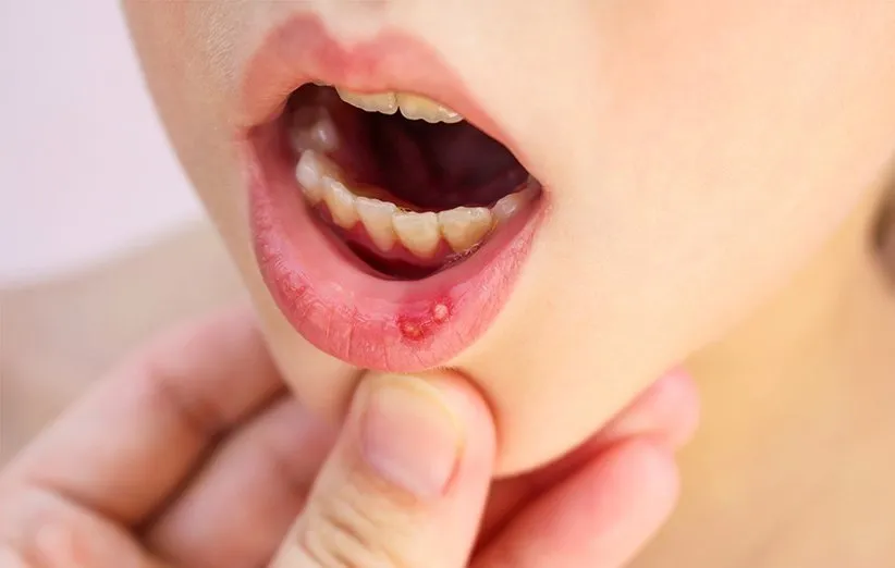 نمک و درمان زخم‌های دهانی