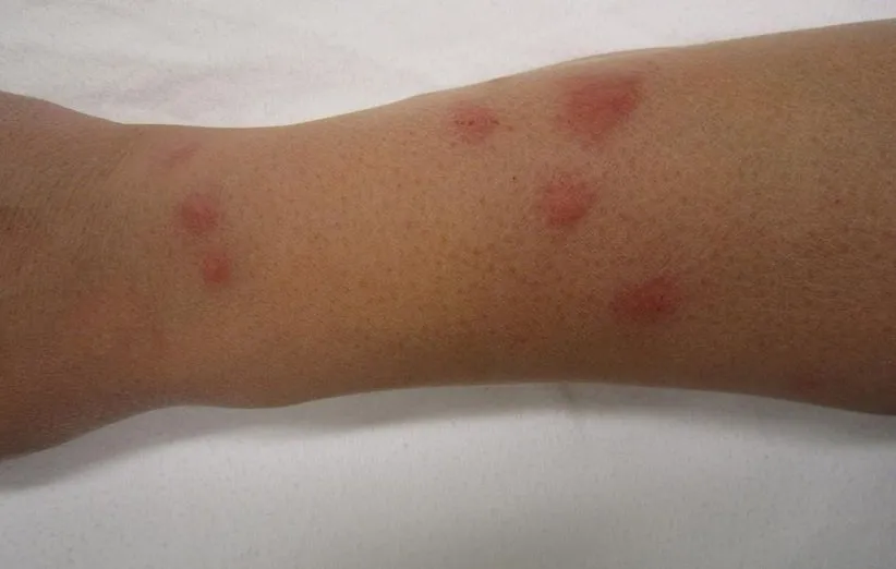 نمک و درمان گزش یا نیش حشرات