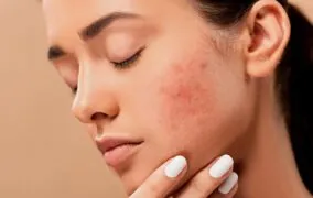 مواد غذایی عامل ایجاد آکنه