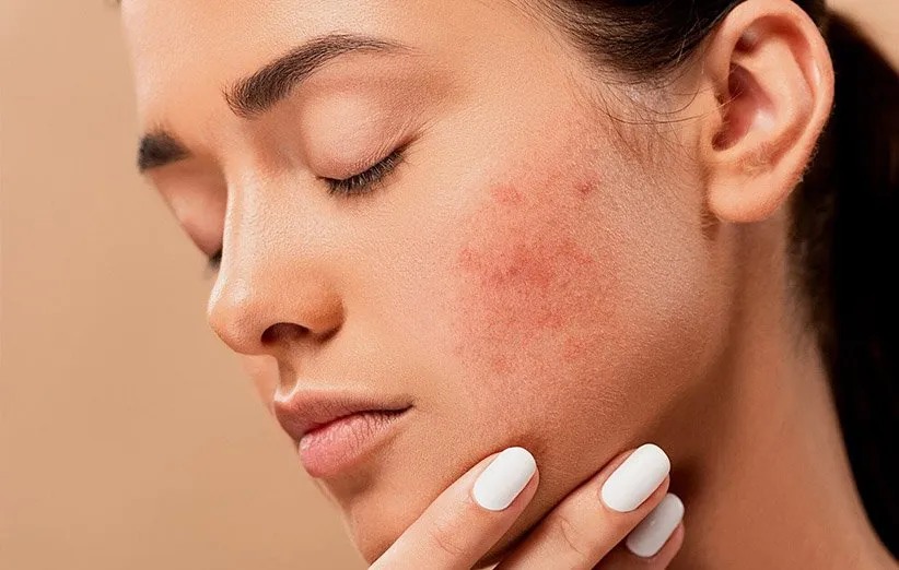 مواد غذایی عامل ایجاد آکنه