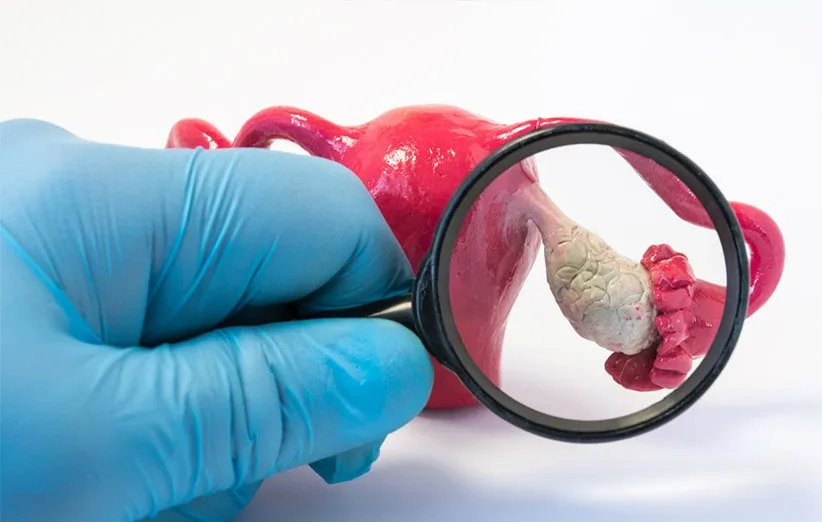 سندروم تخمدان پلی کیستیک