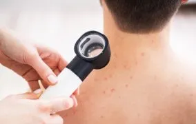 روش‌های طبیعی برای درمان جوش کمر