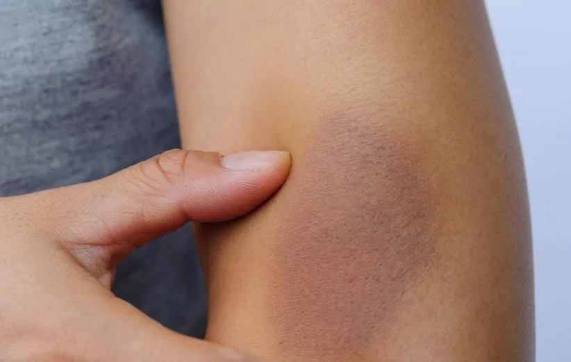 درمان کبودی از خواص فندق افسونگر