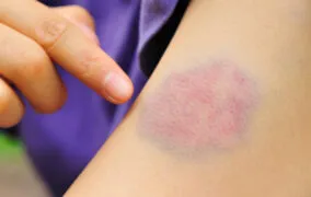 درمان کبودی با روش‌های خانگی