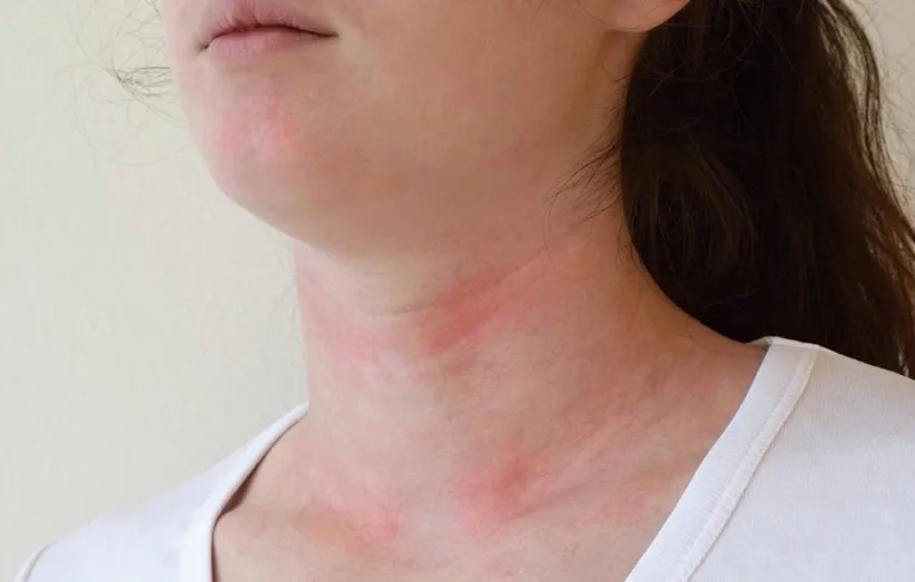 بثورات پوستی