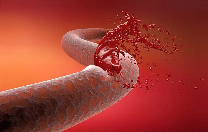 درمان خونریزی