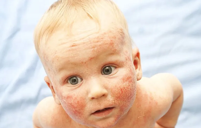 اگزما در کودکان