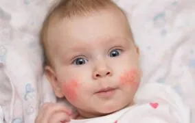 اگزما در کودکان