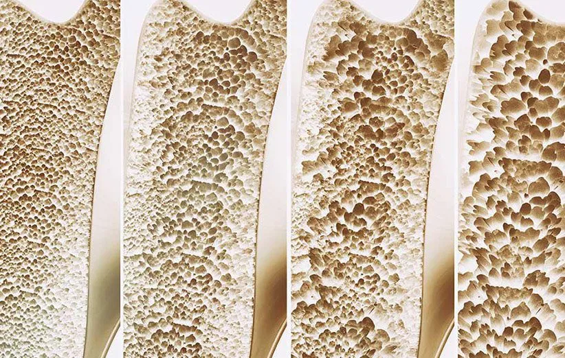 پوکی استخوان