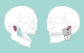 عضله‌ی تازه کشف شده از پشت استخوان گونه تا زائده‌ی عضلانی جلویی فک پایین
