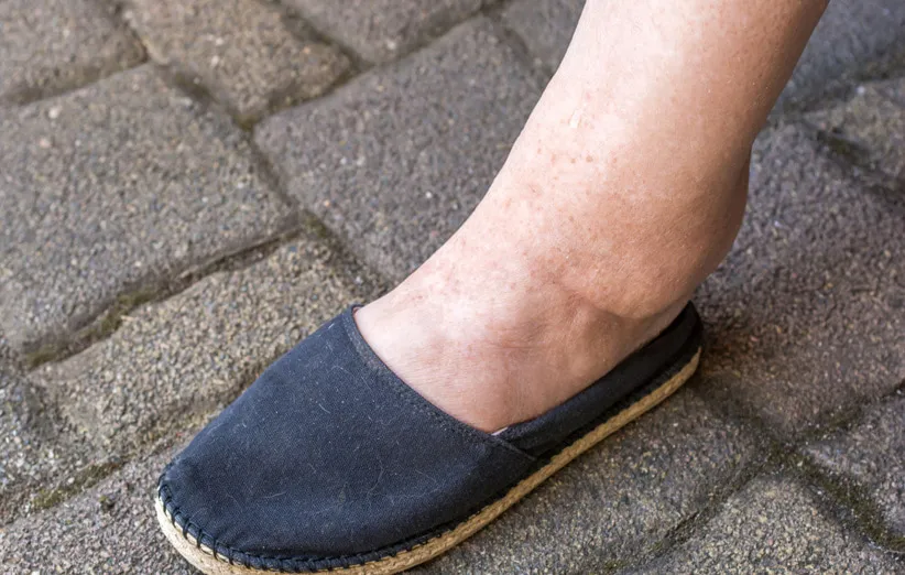 دلایل احتباس آب در بدن