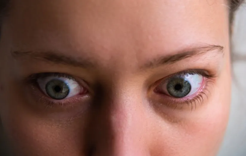 بیماری گریوز چشمی