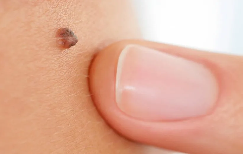 خالهای پوستی