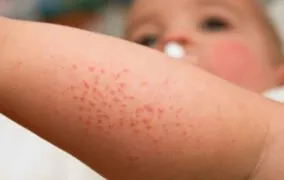 23 روش پیشگیری و درمان عرق سوز شدن در فصل تابستان