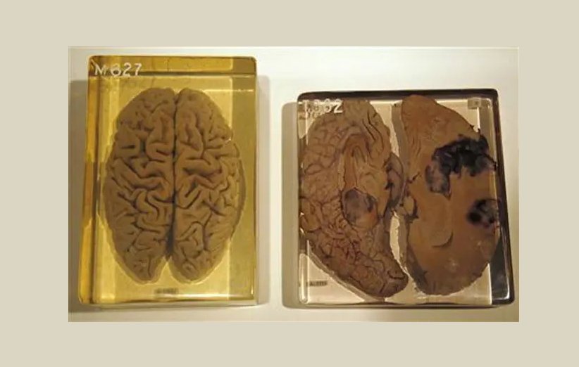 مغز انیشتین