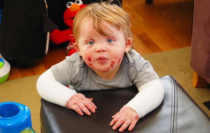 بیماری پروانه ای