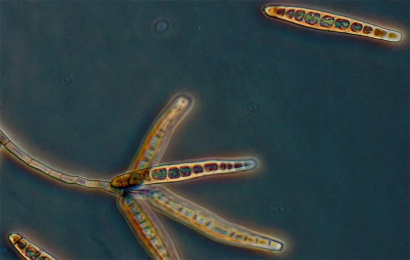 بیماری مننژیت