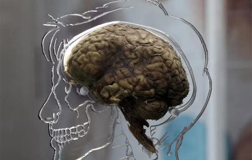 سندرم کوتارد