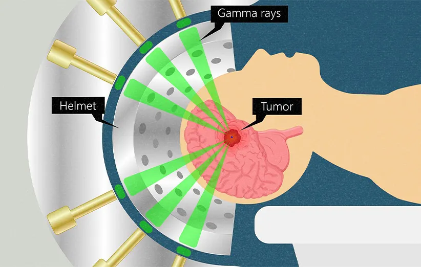 رادیوتراپی
