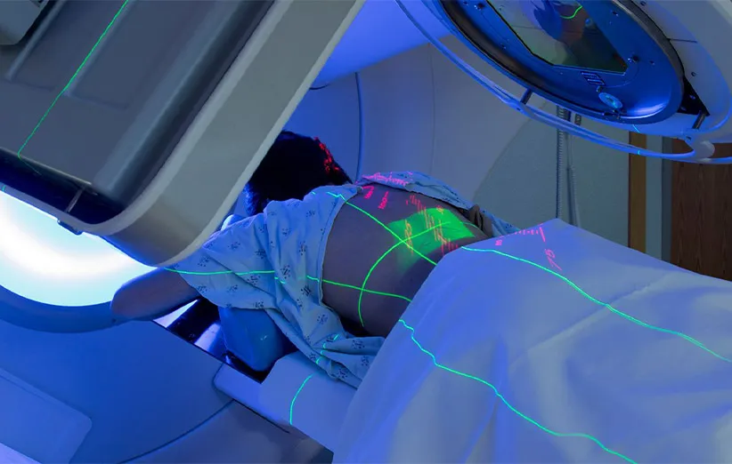 رادیوتراپی