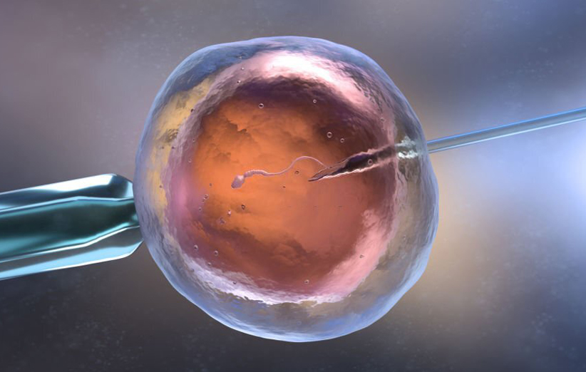 IVF به روش تزریق داخل سیتوپلاسمی اسپرم