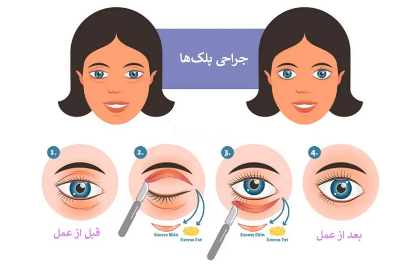 جراحی پلک بالا و پلک افتاده چگونه انجام میشود؟