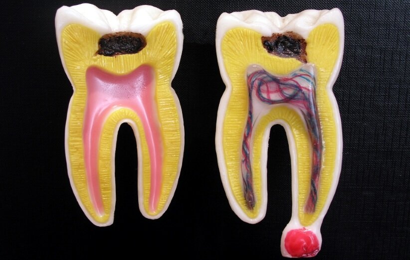 تغییر شکل دندان به وسیله اسید از باکتری 