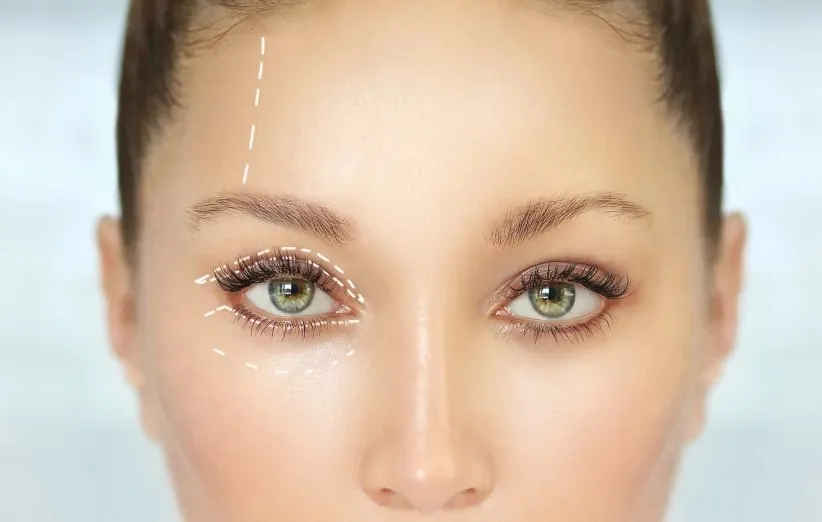 هر آنچه باید در مورد عمل پلك چشم بدانید!