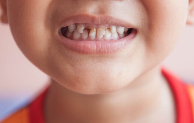 مراقبت از دندان کودکان جلوگیری از پوسیدگی دندان شیری کودک