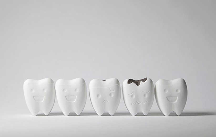 همه چیز درباره پوسیدگی دندان و درمان آن