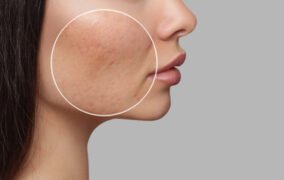 هفت روش درمان منافذ باز پوست