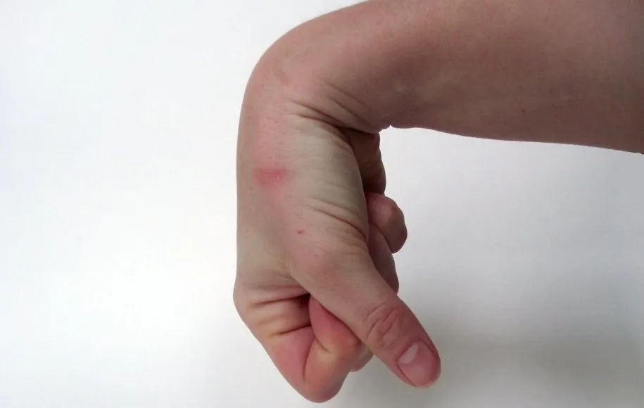 کشش اکستنسور