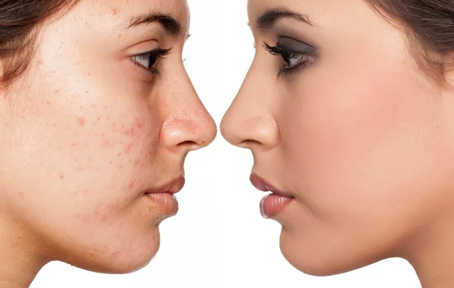 سرم سالیسیلیک اسید