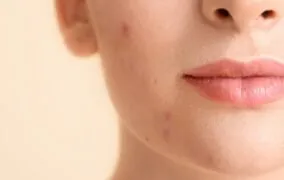 آکنه هورمونی چیست و چگونه باید آن را درمان کنیم؟