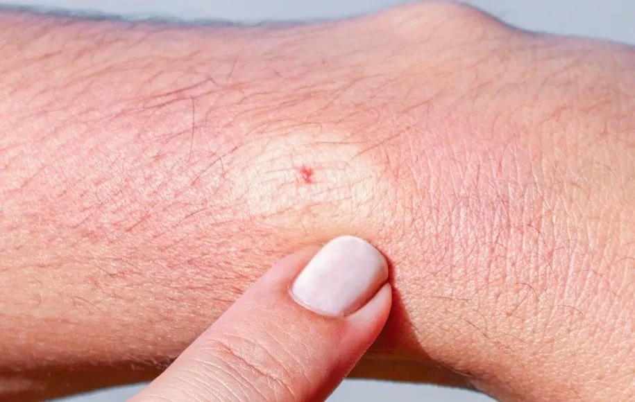 درمان نیش زنبورهای وحشی