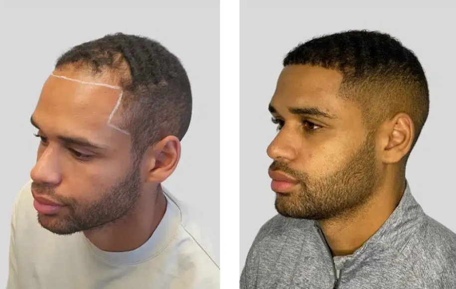 عکس کاشت مو بعد از دو ماه