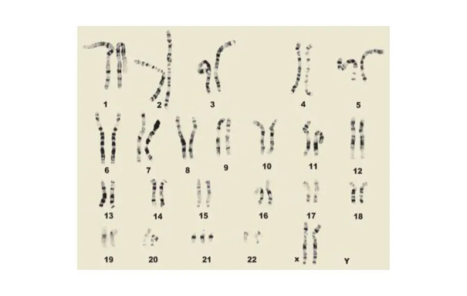 سندرم داون از چند ماهگی قابل تشخیص است؟
