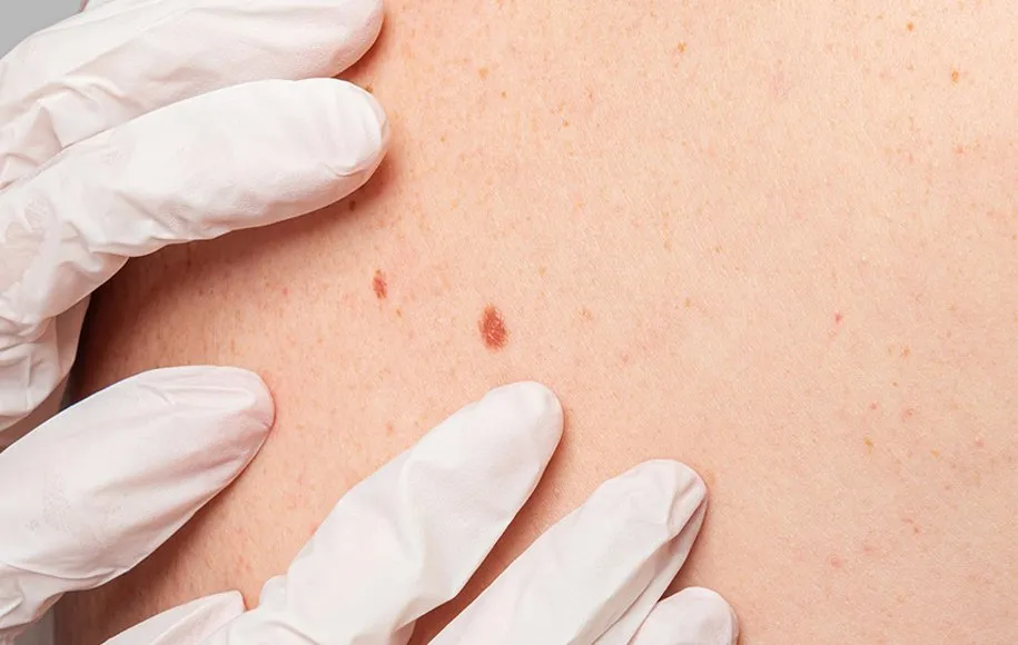 وجود لکه یا جوش روی بدن به عنوان علائم بیماری سرطان