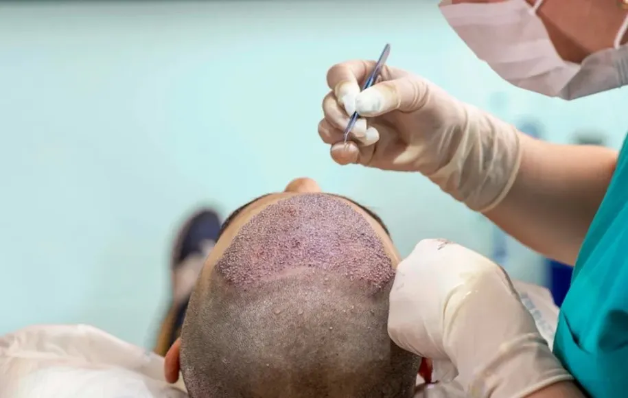 کاشت مو بعد از ۱۰ روز