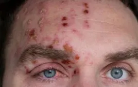 بیماری زونا یا شینگلز