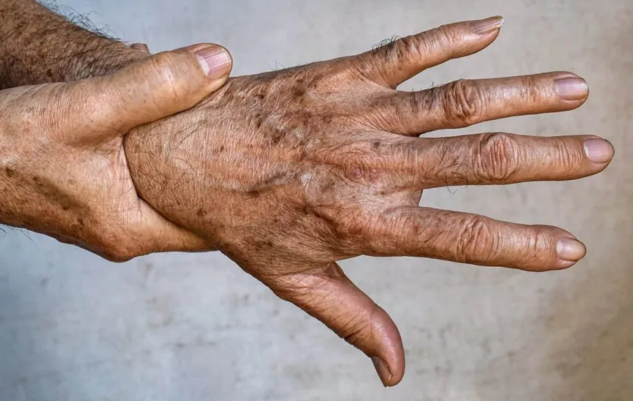 درمان لکههای پوستی ناشی از افزایش سن